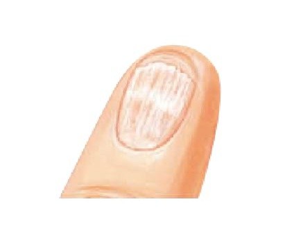 太常做光疗让指甲断裂、分层？6种常见甲面问题“居家诊断法”